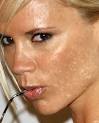 15 Celebrities With Bad Skin