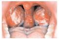 Interhomeopathy - Cadmium phosphoricum in glandular fever