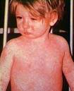 MEASLES Rash Picture (Hardin MD / CDC)