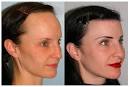 Female Hair Loss: Remedy for Hair Loss