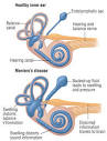 Meniere's Disease Guide: Causes, Symptoms and Treatment Options