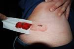 File:<b>Biopsie</b> de la fesse02.JPG