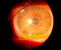 <b>Queratitis por Acanthamoeba</b>