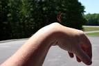 Ganglion Cysts: What You Need To Know - The Fun Times Guide to ...