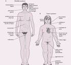 Klinefelter's Syndrome Pictures