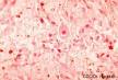 Cytomegalovirus Infections: MedlinePlus