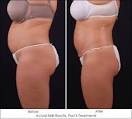 Exilis Reviews  Who Is The Ideal Patient    AmericanHealthAndBeauty