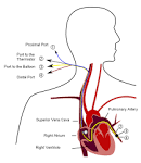 File:<b>Pulmonary artery</b> catheter