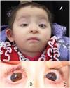 bilateral iris
