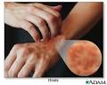 Anaphylactic Shock