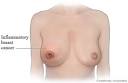 Inflammatory Breast Cancer - Health.