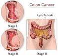Colon Cancer