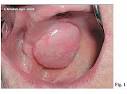 <b>Adenoma</b> A Cellule Epatiche
