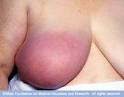 http://www.mayoclinic.com/images/image_popup/br7_inflammatory.jpg