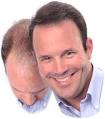 Hair Loss Treatment For Men | Health and Beauty - Smart Girl ...
