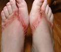 Are Flips Flops Bad? | Advanced Foot and Ankle Center