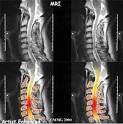 Diagnosis of Degenerative Disc Disease in the Neck