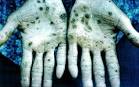 ARSENIC Toxicity
