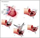 Surgery.com - Aortic Valve Replacement Information, Surgery Costs ...