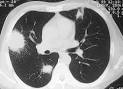 <b>Granulomatosi di Wegener</b>- Rx