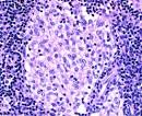 stuffed with <b>histiocytes</b>