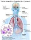<b>Infectious Mononucleosis</b>