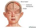 <b>Subdural hematoma</b>