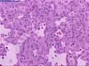 Slide: Bladder : Angiosarcoma | Webpathology.
