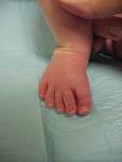 When <b>Hallux Varus</b> Plays A Role