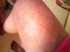 I've finally healed my KP.. Pictures included. - Page 2 ...