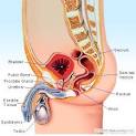 Testicular Pain Causes, Symptoms, Diagnosis, and Treatment on ...