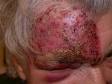 What Its Like to Really Experinece MORGELLONS DISEASE, Full Out.