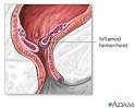 Hemorrhoid surgery - series: MedlinePlus Medical Encyclopedia