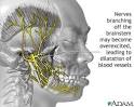Migraine cause -
