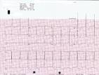 Apical HYPERTROPHIC CARDIOMYOPATHY - Ask Dr Wiki