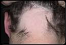 Alopecia Areata Picture Image on MedicineNet.