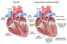 HCM anatomy PI