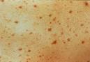 HIV Rash Picture