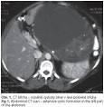 <b>Cystadenom</b>, <b>seröst</b> www.lookfordiagnosis.com www.lookfordiagnosis.com