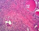 <b>Thyroiditis</b>, <b>Subacute</b>