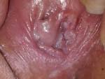 have A LOT of white cluster-like bumps inside my vagina. they ...
