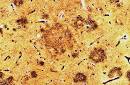 Amyloid Plaque Pictures