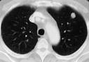 <b>pulmonary</b> "<b>coin</b>" <b>lesion</b>