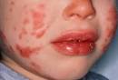 Kawasaki Disease targets the