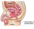 <b>Prostatitis</b>