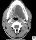 Simple <b>ranulas</b> usually treated