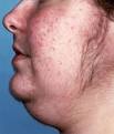 Diagnosing Cushing's syndrome