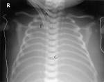 <b>Meconium aspiration syndrome</b>