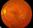 <b>macular degeneration</b>.