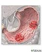 Peptic Ulcer: MedlinePlus